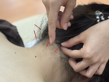 くまはら接骨院 所沢院/辛い頭痛には鍼がピッタリ！