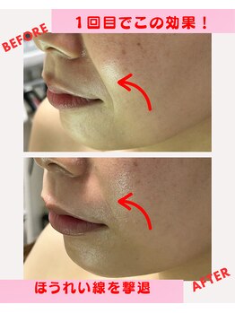 ユーフォリア(Euphoria)/ほうれい線、撃退できる喜び!