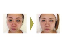 おうちサロン しゅろ/ハーブピーリング　B/A