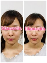 ブランソワン/イオン導入でツヤ肌！