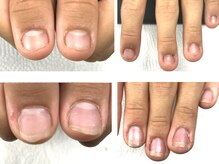 自爪ケアサロン 横浜/爪が伸びるとこんなに変わる