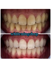 ホワイトニングショップ 大阪玉造店/【お試しコース】ホワイトニング