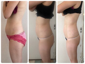 アンドモア(&more)/痩身症例