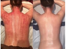 マーズ(Mars)/脂肪セル撃退