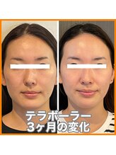 レミュー(remiu)/小顔テラボーラー