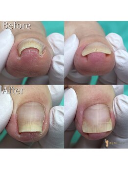 巻き爪補正店 札幌店/【巻き爪補正】