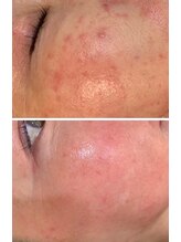 宮本鍼灸整骨院/和漢ハーブピーリング