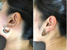 エヴァワックス 恵比寿店(Eva Wax)/【もみあげ脱毛】ビフォ-アフタ-