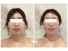 美極 銀座店/銀座/小顔コルギ/小顔矯正