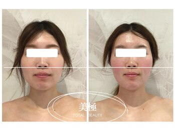 美極 銀座店/銀座/小顔コルギ/小顔矯正