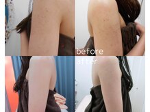 オリス 名古屋店(oliss)/二の腕before/after