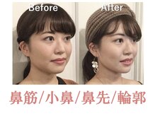 ラプリ 仙台店(Raplit stella)/隆鼻矯正+輪郭40分 10回