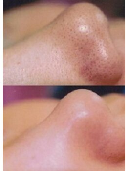 セゾン/角栓、黒ずみ、毛穴レス美肌◎