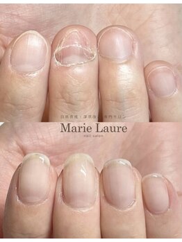 マリーロール 天王寺店(Marie Laure)/自爪育成/深爪矯正/ネイルケア