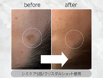 ベリール バイ ラスティ(Belile by LUSTY)/シミケア+クリスタルショット