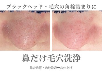 エクラ イオンモール徳島店(ECLAT)/鼻だけ毛穴洗浄