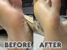 ポドロ ウィズ ニコルル 大阪天満店(PoDoLo with Nicolulu)/【魚の目】フットケア大阪・梅田