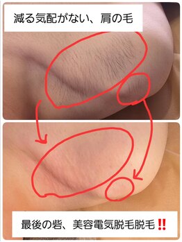 ベビースキン(baby skin)/美容電気脱毛