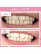 エクシアホワイト 新宿御苑店(ecxia white)/ホワイトニングビフォーアフター