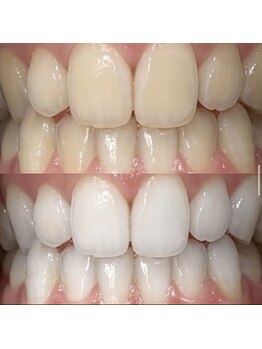 ホワイトニングセンター 京都長岡京店/長岡京・大山崎ホワイトニング