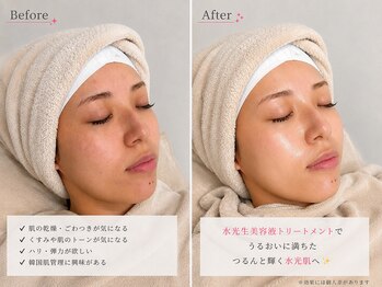 サロンドルル(salon de lulu.)の写真/【圧倒的ハリツヤ感】ピーリングと水光生美容液で満ちる潤い!内側から輝く水光肌を叶える☆