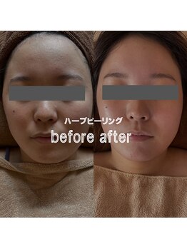 ウーマンビーヘルス(woman Be Health)/ハーブピーリング3回