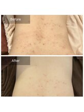 ビビ(VIVI)/背中ニキビケアハーブピーリング