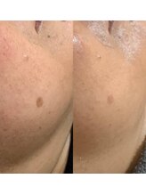 エンビロントリートメント＋シミケア月に１度のサロントリートメント♪