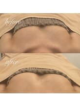 ミリム(milim)/【バストアップ/育乳】症例