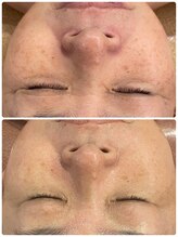 オレアグリーン 岡崎(OLEA green)/ブラックハーブ５回