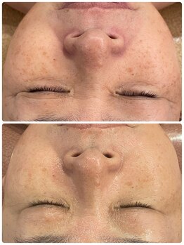 オレアグリーン 岡崎(OLEA green)/ブラックハーブ5回