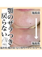 ピュール 鯖江店(PUR)/毛穴サロン/毛穴ケア/毛穴洗浄