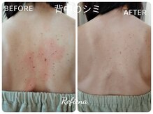 クリニカルエステ リフィーナ 西荻窪店の雰囲気（お身体のシミケアもお任せください！１００分１９６００円）