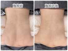 シェミー(CHEZ MEE)/【美ボディ】背中ニキビ・引締め