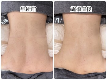 シェミー(CHEZ MEE)/【美ボディ】背中ニキビ・引締め