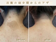 ホウビ(HOUBIE)の雰囲気（《アザ》医療でも改善が難しい幼少期からある茶アザ改善ケア）