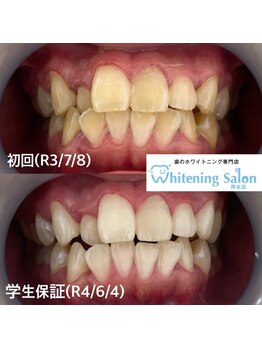 ホワイトニングサロン 熊本店/当店が1番安いホワイトニング