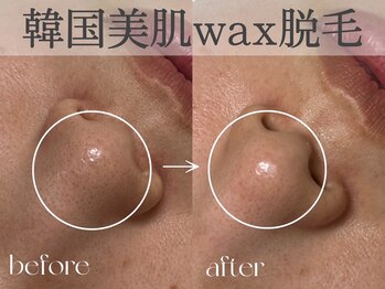 エルミュ(Elmu)/韓国美肌ワックス脱毛