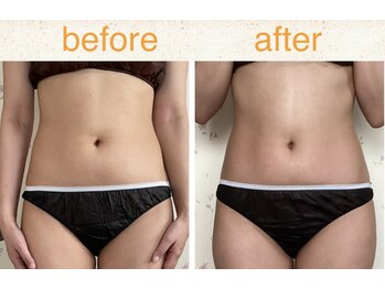 ラレコルト/ビフォーアフター