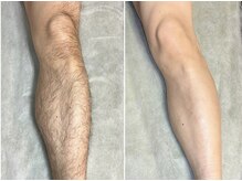 スタイリッシュビューティー(stylish beauty)/近年急増中,女性うけNO.1脚脱毛