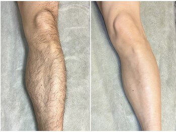 スタイリッシュビューティー(stylish beauty)/近年急増中,女性うけNO.1脚脱毛