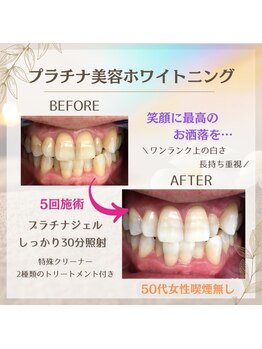 ホワイトニングプラス(Whitening+)/早く白く!後戻りも少なく