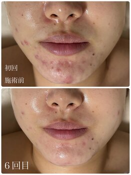 メロー(MELLOW)/ハーブピーリング(ニキビケア)