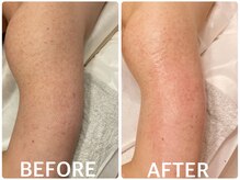 ハーブピーリング 恵比寿/二の腕/ニキビ/毛孔性 苔癬