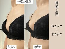 ソワ(soie)/産後でも1度の施術で1カップUP