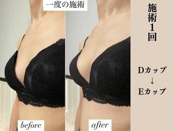 ソワ(soie)/産後でも1度の施術で1カップUP