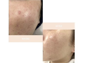 エムズ(M’s)/ニキビケア