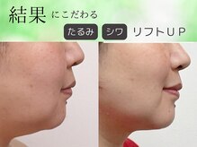 シーズボーテ(C's Beaute)/結果重視◎人気のレモンボトル★