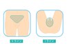 【快適生活】VI（玉＋竿）脱毛　7700円→4400円