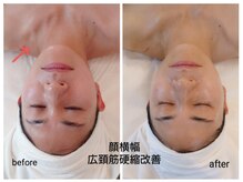 エステティック ブランシュール(Blancheur)/インディバフェイシャル９０分